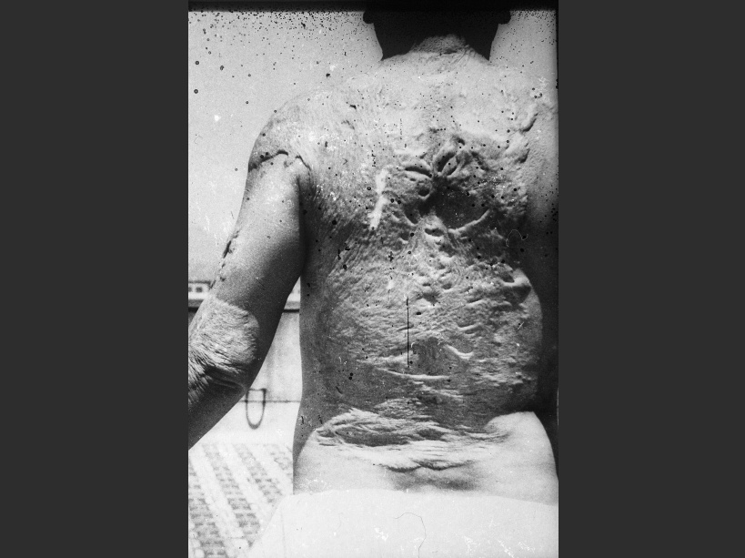 Le dos d'une victime du bombardement d'Hiroshima - © SIPA/RETRO/LIBRARY OF CONGRESS/E.R.L.